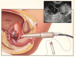 ivf-1